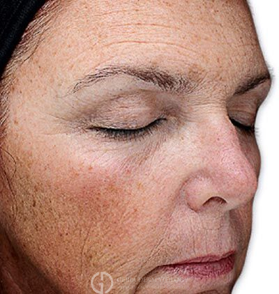 Before Image: Patient Case #6020 - right-front-oblique