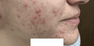 Before Image: Patient Case #2959 - right-side