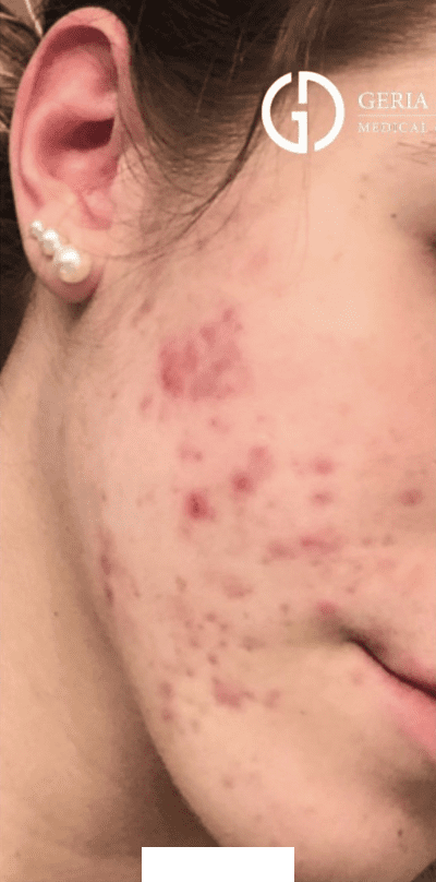 Before Image: Patient Case #2960 - right-front-oblique