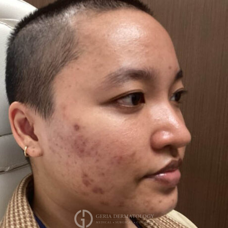 Before Image: Patient Case #4778 - right-front-oblique