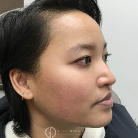 After Image: Patient Case #4778 - right-front-oblique