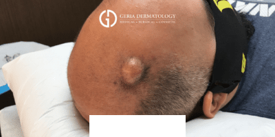 Before Image: Patient Case #2974 - right-back-oblique