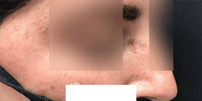 Before Image: Patient Case #3960 - right-front-oblique