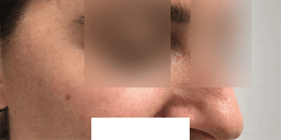 After Image: Patient Case #3960 - right-front-oblique