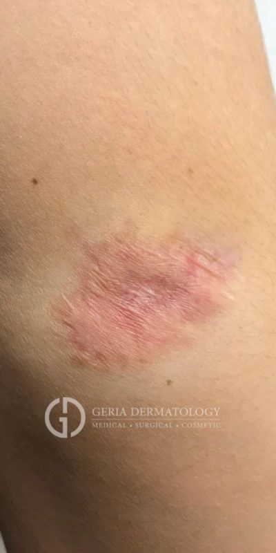 After Image: Patient Case #7071 - right-front-oblique