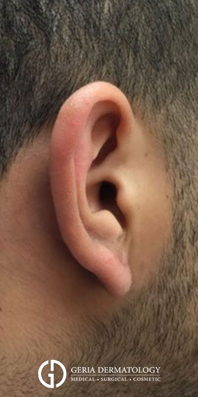 After Image: Patient Case #4069 - right-side