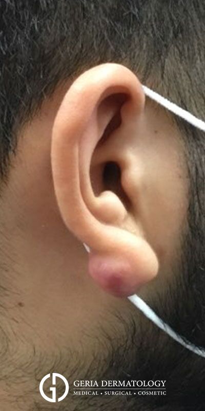 Before Image: Patient Case #4069 - right-side