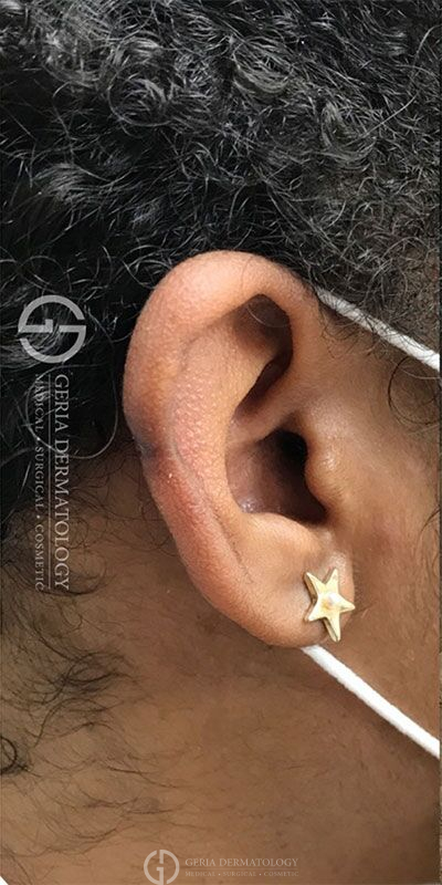 After Image: Patient Case #3915 - right-side