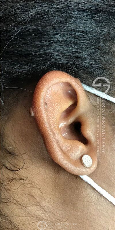 Before Image: Patient Case #3915 - right-side