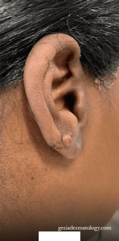 After Image: Patient Case #3025 - right-side