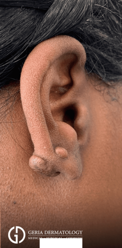 Before Image: Patient Case #3025 - right-side