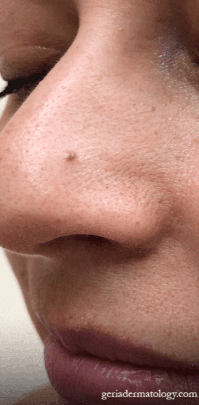 After Image: Patient Case #2930 - left-front-oblique