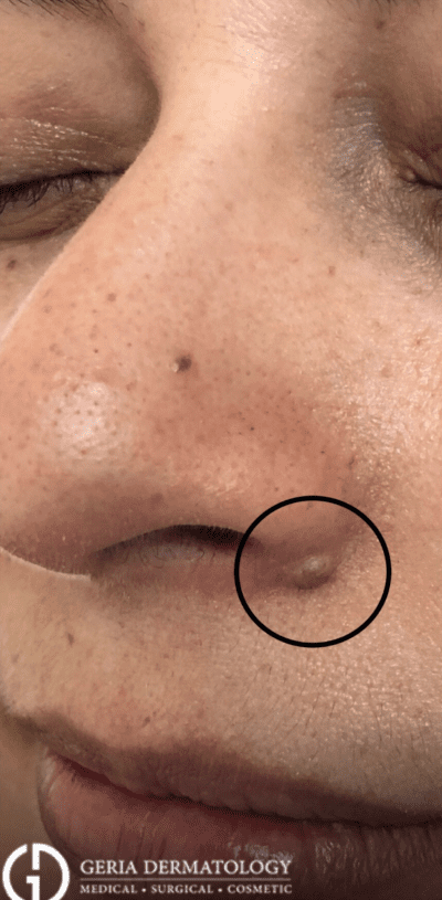 Before Image: Patient Case #2930 - left-front-oblique