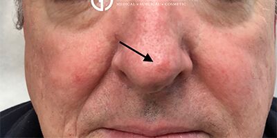 After Image: Patient Case #1703 - front