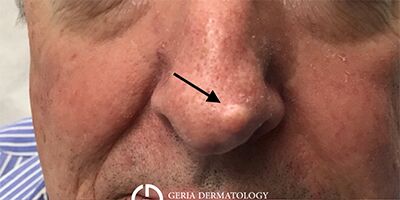 Before Image: Patient Case #1703 - front