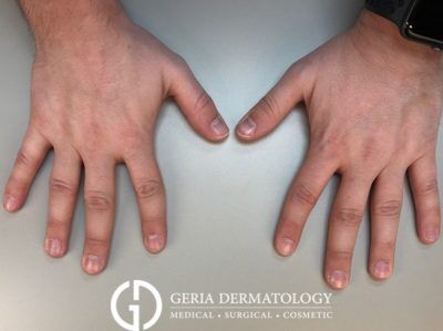 Before Image: Patient Case #5111 - front