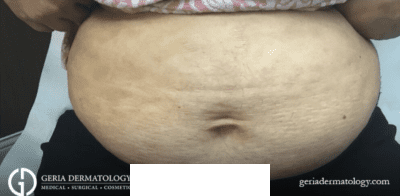 After Image: Patient Case #2953 - front