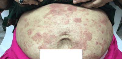 Before Image: Patient Case #2953 - front