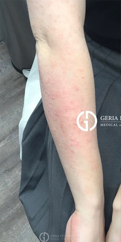 Before Image: Patient Case #1731 - front