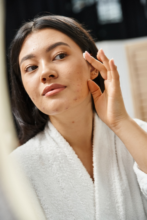 Acne Treatments Near Me in Verona & Rutherford | Geria Dermatology in New Jersey