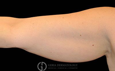 Before Image: Patient Case #2732 - front