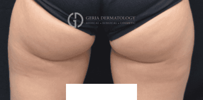 Before Image: Patient Case #2926 - back