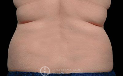 Before Image: Patient Case #2599 - back