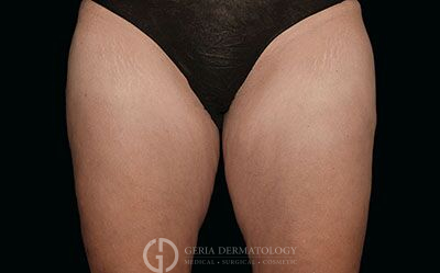 After Image: Patient Case #2604 - front