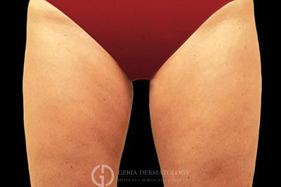 After Image: Patient Case #2701 - front