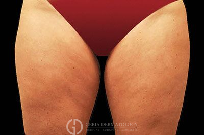 Before Image: Patient Case #2701 - front