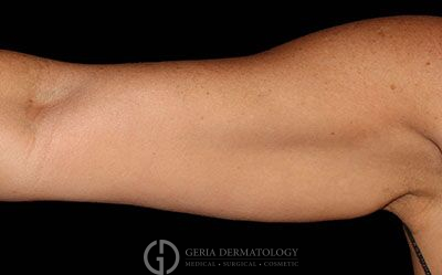 After Image: Patient Case #2703 - front