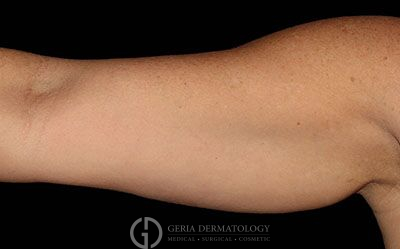 Before Image: Patient Case #2703 - front