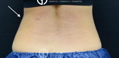 After Image: Patient Case #271 - back