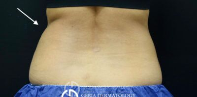 Before Image: Patient Case #271 - back