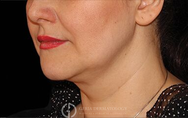 After Image: Patient Case #273 - left-front-oblique