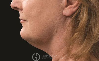 After Image: Patient Case #2731 - left-side