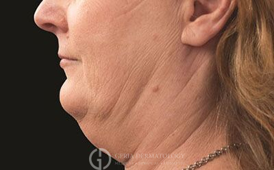 Before Image: Patient Case #2731 - left-side