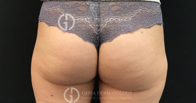 After Image: Patient Case #11580 - back