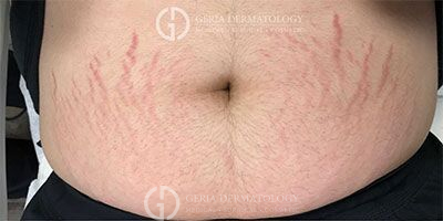 Before Image: Patient Case #3963 - front