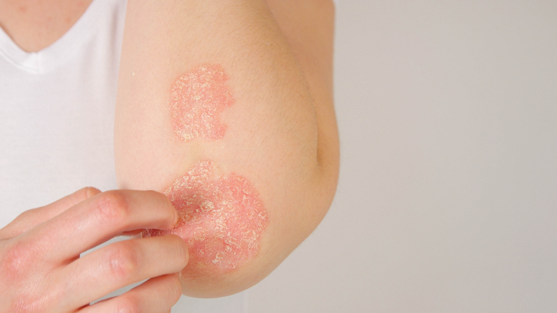 Psoriasis Treatment In New Jersey | Geria Dermatology