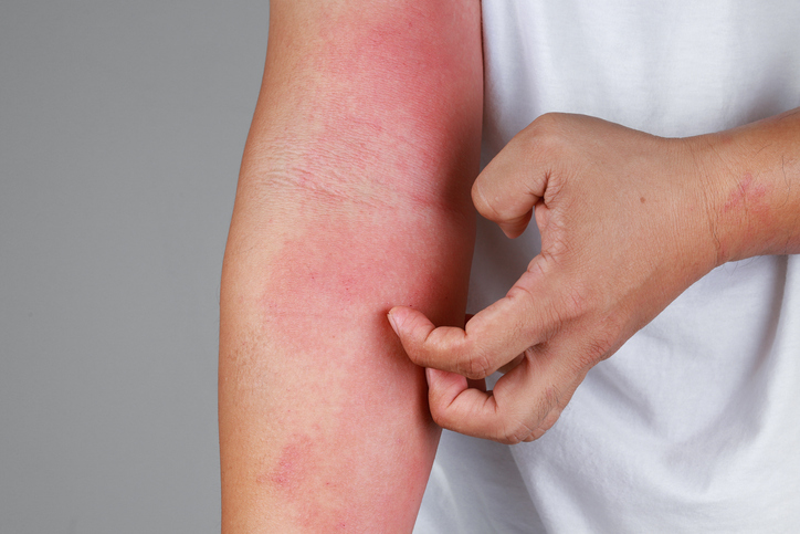 Eczema Treatments Near Me in Verona & Rutherford | Geria Dermatology in New Jersey