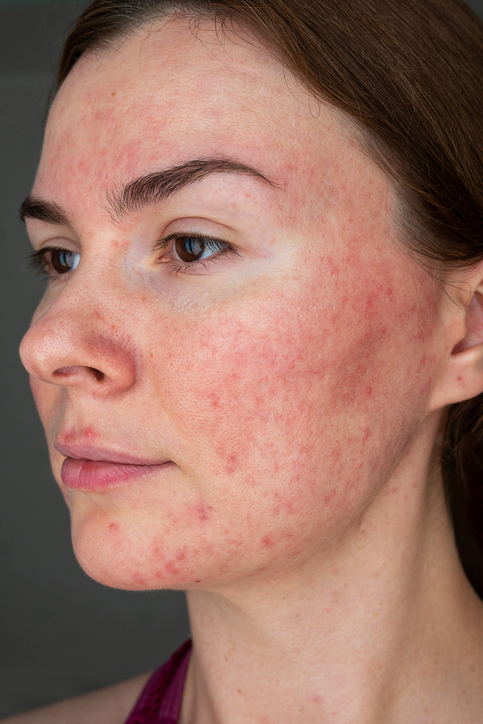 papulopustular rosacea, face close up Rosacea In New Jersey | Geria Dermatology