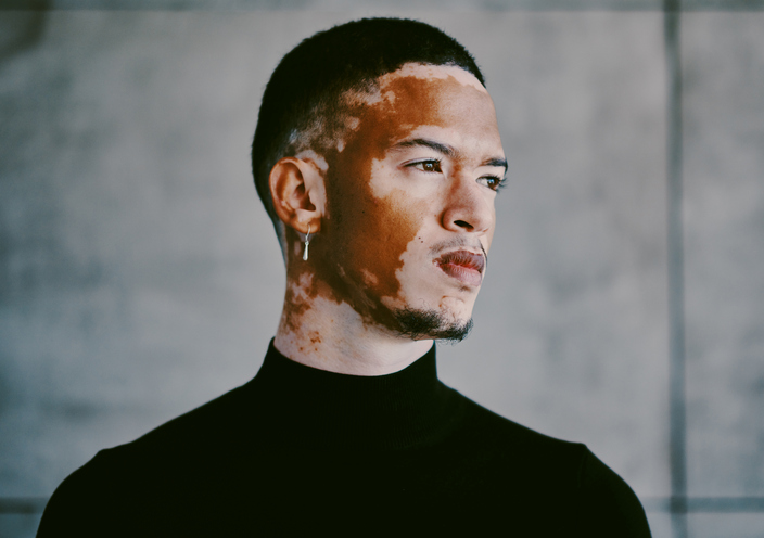 Xtrac Laser In New Jersey | Geria Dermatology