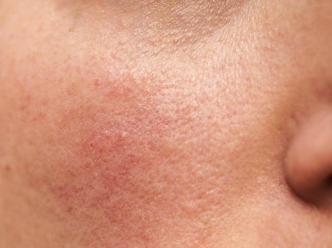 Rosacea In New Jersey | Geria Dermatology
