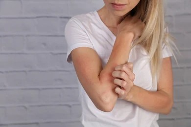 A cropped shot of a woman with eczema scratching her arm