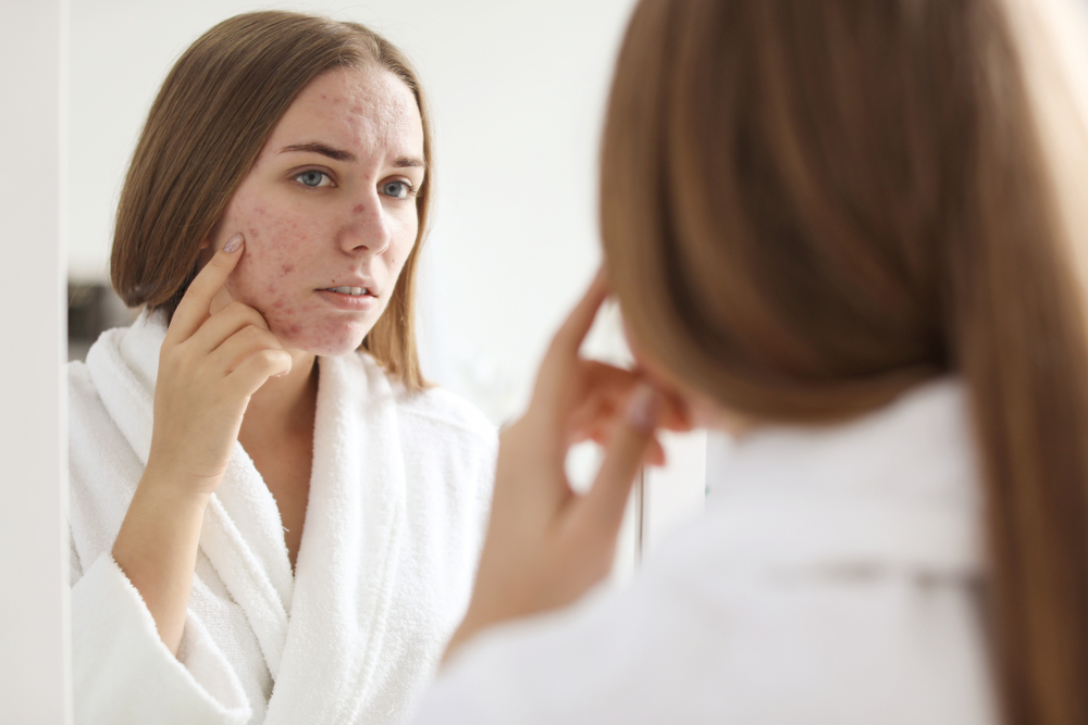 A woman with acne looking in the mirror A woman with acne looking in the mirror