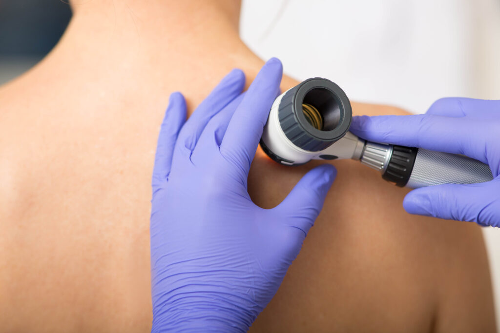 A dermatologist examining basal cell carcinoma on a woman's shoulder