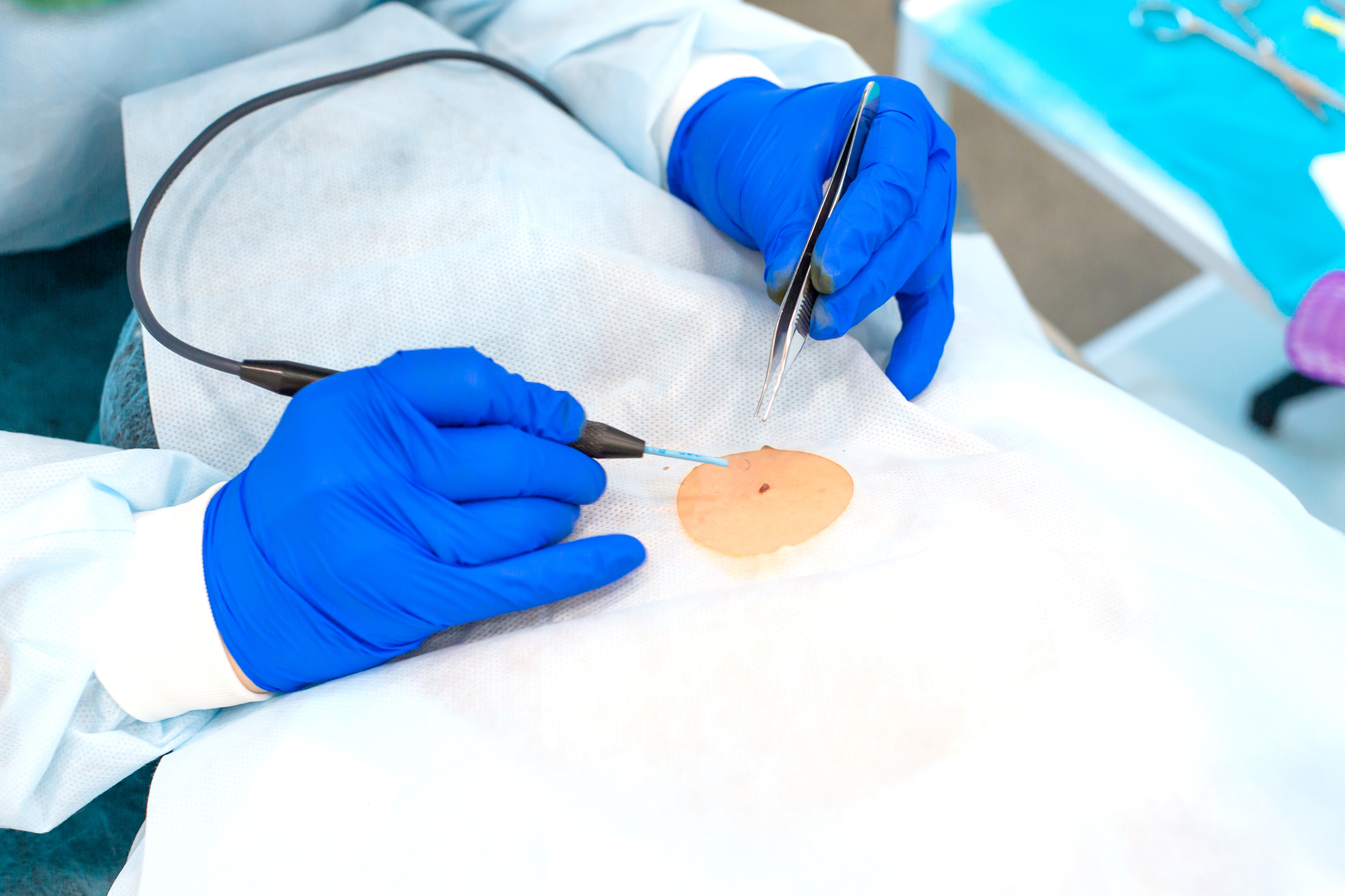 Close-up surgeon burns a mole on the back of the patient. Mole Removal Surgery Procedure Mohs Surgery in Verona, NJ: Advanced Skin Cancer Treatment