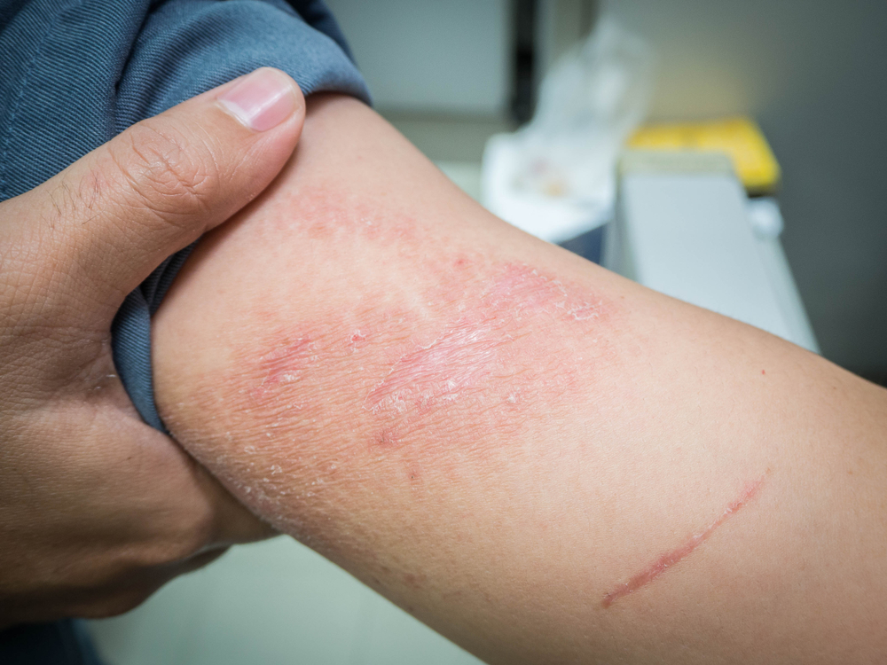 Close-up of a person scratching a red eczema rash on their arm.