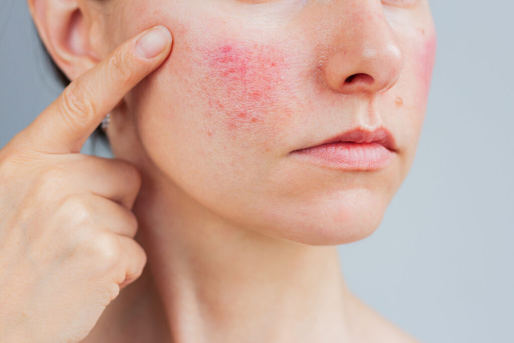 Close-up of facial redness and visible blood vessels associated with rosacea and pigmentation concerns. Close-up of facial redness and visible blood vessels associated with rosacea and pigmentation concerns.